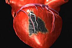Названы симптомы надвигающегося инфаркта