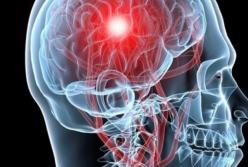 Названы самые эффективные способы предотвратить инсульт