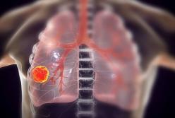 Онкологи указали на необычные признаки рака легких