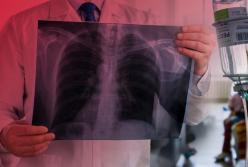 Кабмин утвердил госстратегию развития противотуберкулезной медпомощи