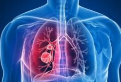 Медики рассказали, от какого вида рака умирает больше всего людей