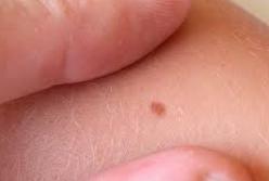 Онкологи рассказали, как распознать первые признаки рака кожи