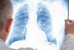 Медики назвали первые симптомы начинающейся пневмонии