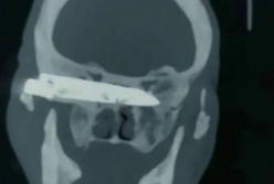 Мужчина 26 лет жил со ржавым ножом в голове прежде, чем его достали хирурги (фото)