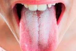 Врачи рассказали, о каких болезнях говорит налет на языке
