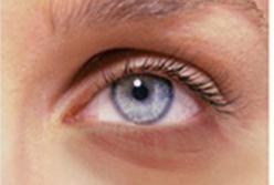 Как избавиться от синяков под глазами подручными способами