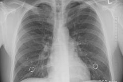 Медики назвали ранние симптомы рака легких