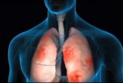 Медики рассказали, как распознать бессимптомную пневмонию