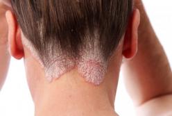 Медики назвали еду, влияющую на лечение псориаза