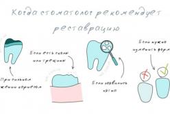 Что такое реставрация зуба, как проводят процедуру?