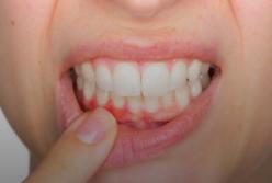 Врачи рассказали, о каких болезнях сигнализирует воспаление десен