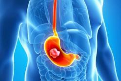 Ученые назвали самые распространенные симптомы рака желудка