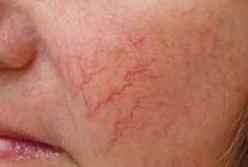 Медики рассказали, о каких болезнях предупреждают лопнувшие капилляры