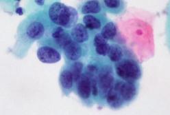 Ученые узнали о новой причине появления рака кожи