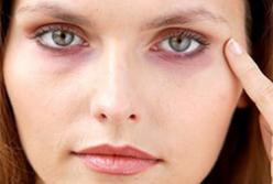 Как убрать синяки под глазами: самые эффективные методы