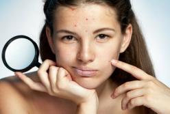 Эндокринологи назвали главные признаки нарушения гормонального баланса