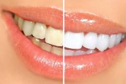 Стоматологи подсказали, как отбелить зубы в домашних условиях