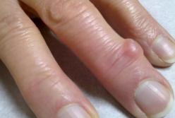 Назван малоизвестный симптом возможного сердечного приступа