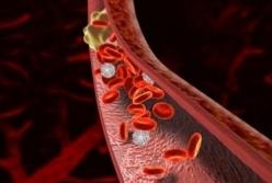 Врачи назвали первые признаки тромбоза