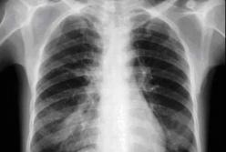 Медики назвали ранние признаки рака легких