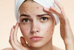 О каких проблемах со здоровьем говорят прыщи на разных частях лица 