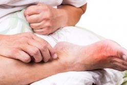 Врачи установили связь между свининой в рационе и подагрой