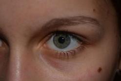 Онкологи объяснили, какой цвет родинок является опасным