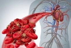 Медики рассказали, что вызывает тромбоз