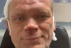 Экс-министра аграрной политики избили двое неизвестных с битами