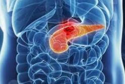Онкологи рассказали, как выявить рак поджелудочной железы на ранней стадии