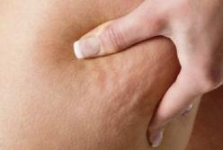 Супрун рассказала, как нужно бороться с целлюлитом