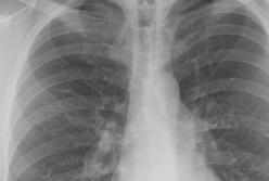 В Украине количество выявленных случаев туберкулеза сократилось на 30%