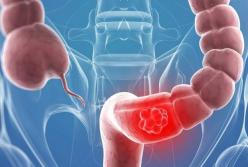 Медики назвали главный предупреждающий симптом рака кишечника