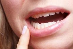 Эксперты назвали народные методы лечения язв во рту