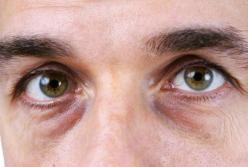 Медики рассказали, как избавиться от мешков под глазами