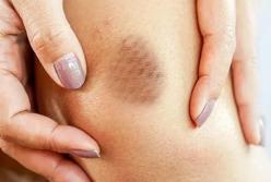 Врач объяснил, на какую проблему указывает внезапное появление синяков