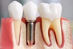 Мифы имплантации зубов