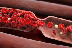 Названы первые признаки образования тромбов в сосудах