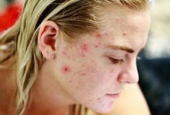 Названы продукты, провоцирующие прыщи и угри на лице