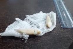 В Индии стоматолог удалил самый длинный в мире человеческий зуб