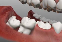 Стоматологи рассказали всю правду о зубах мудрости 