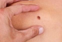 Онкологи назвали главный симптом рака кожи 