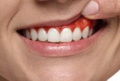 Гінгівіт: як захистити свої ясна від запалення