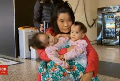 Австралийские хирурги успешно разделили сиамских близнецов (видео)