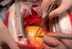На видео попали кадры, как хирурги делают уникальную операцию на сердце (видео)
