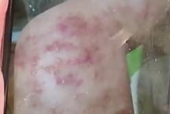 Жуткие ожоги после посещения салона красоты получила молодая женщина (видео)