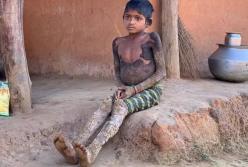 В Индии 7-летняя девочка «превращается в камень» из-за редкого заболевания (видео)