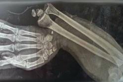 Мальчик съел 150 жевательных витамин на завтрак и вот что с ним случилось 