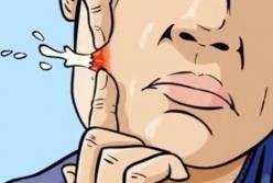 Жуть: что находится внутри прыща? (видео)