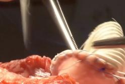 Революция в кардиологии: вырастить клапан сердца из ткани пациента (видео)